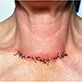 Тиреоидэктомия (экстирпация щитовидной железы): ведение в послеоперационном периоде и наиболее типичные осложнения