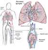 Что нужно знать о тромбоэмболии легочной артерии?